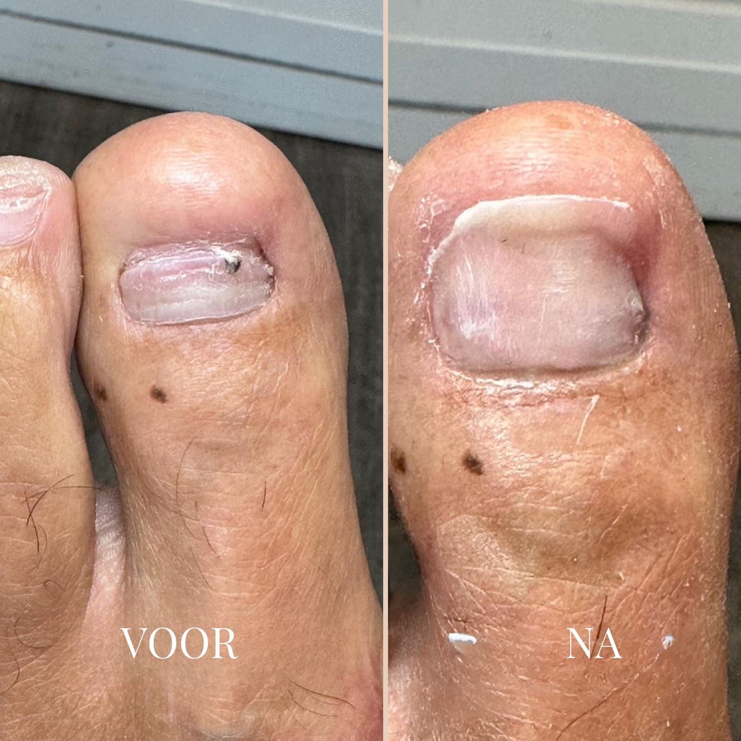 ReviveNail Pleisters | Tegen Kalk- En Schimmelnagels