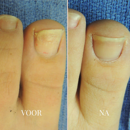 ReviveNail Pleisters | Tegen Kalk- En Schimmelnagels