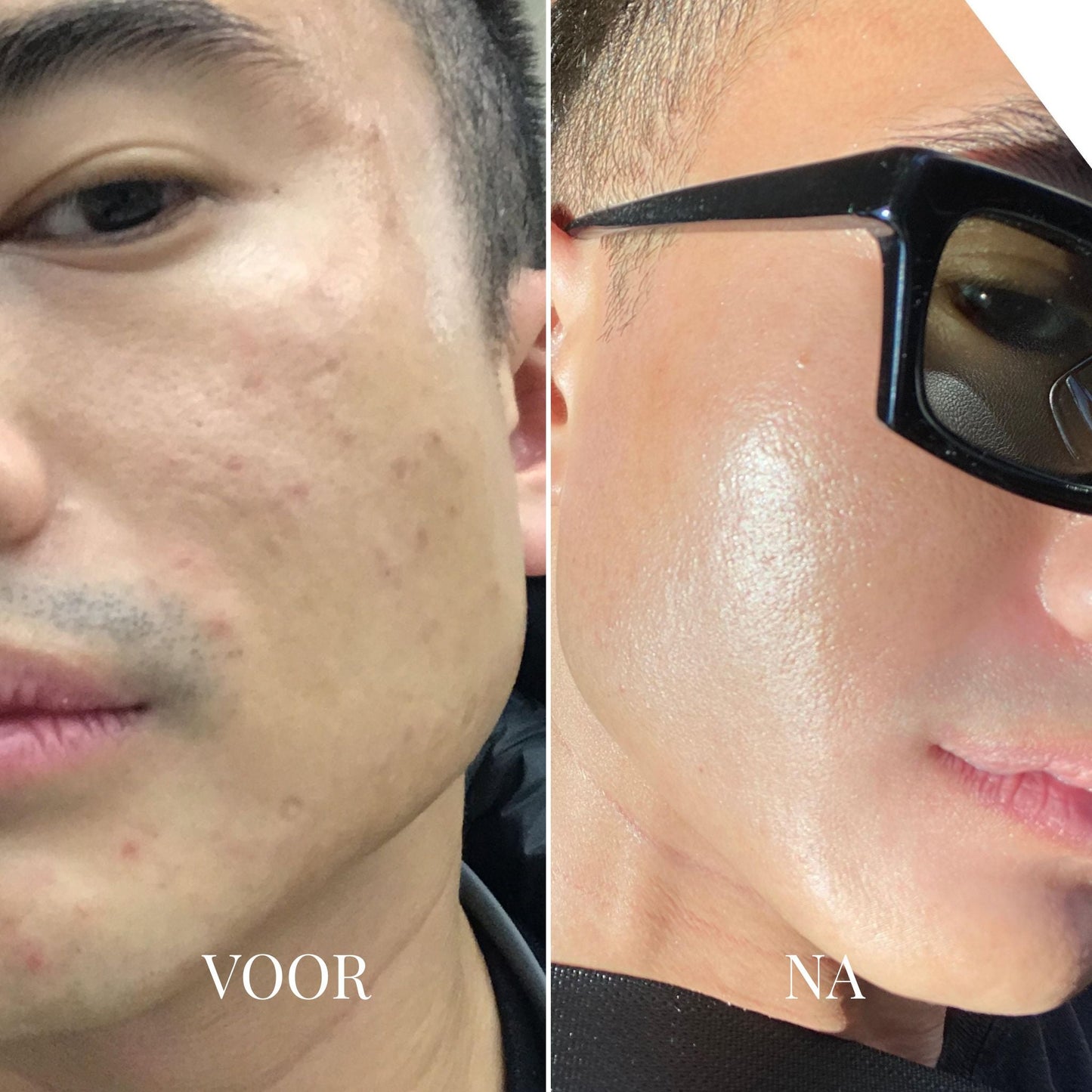 Porify Mee-Eter Verwijderaar