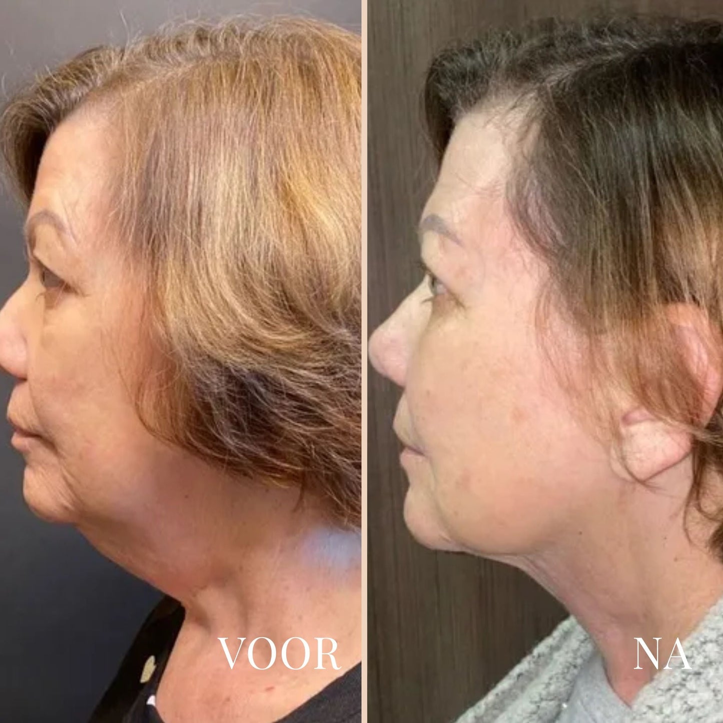 LinaLift Nek en Oog Versterker Creme