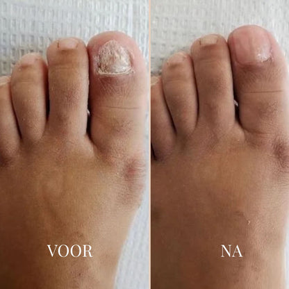 ReviveNail Pleisters | Tegen Kalk- En Schimmelnagels