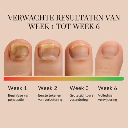 ReviveNail Pleisters | Tegen Kalk- En Schimmelnagels